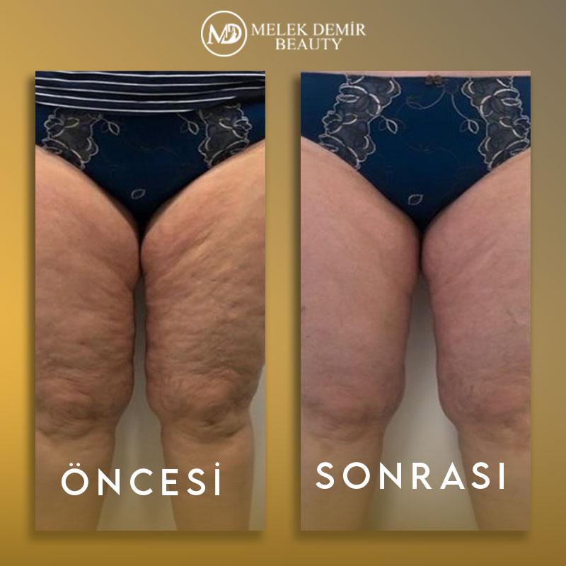 before-after