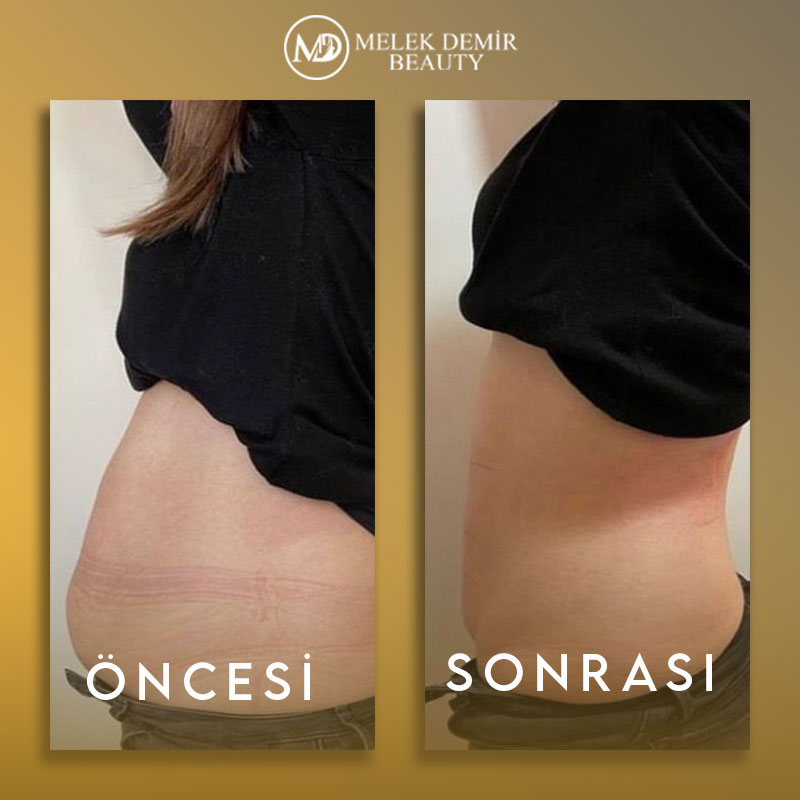 before-after