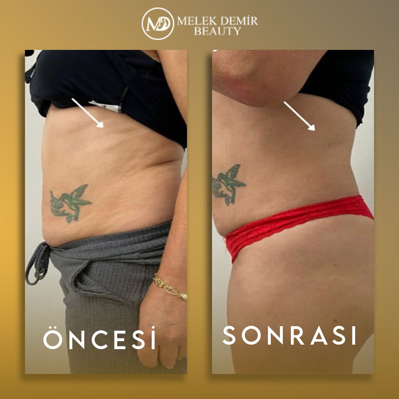 before-after