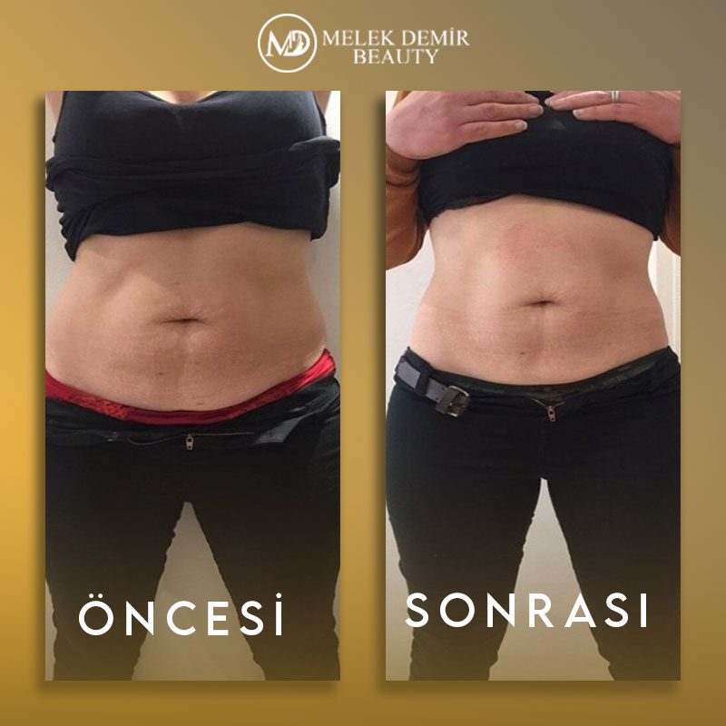 before-after