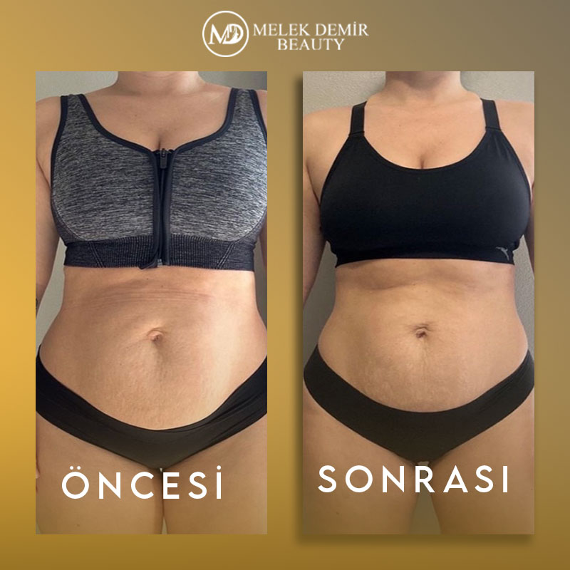 before-after