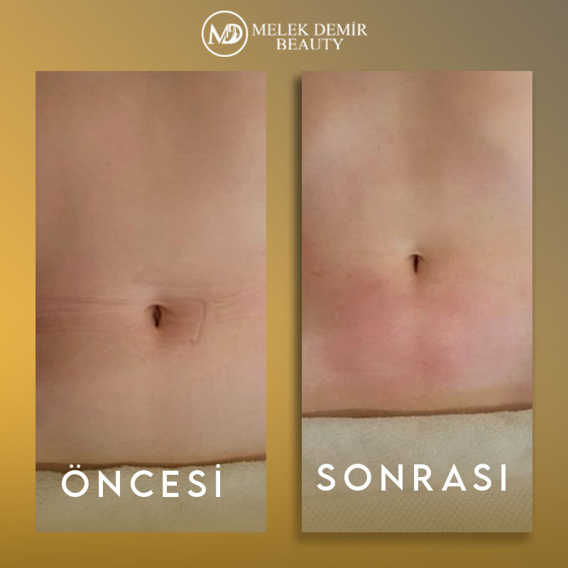 before-after