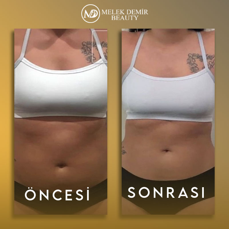 before-after