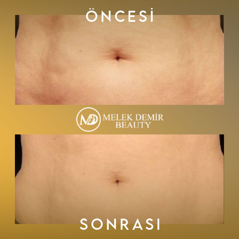 before-after