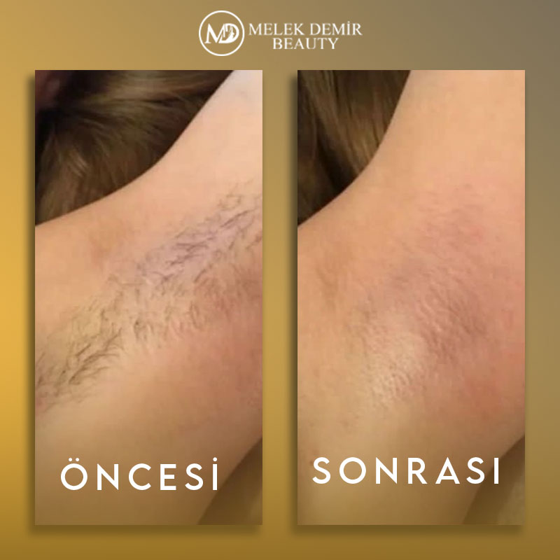 before-after