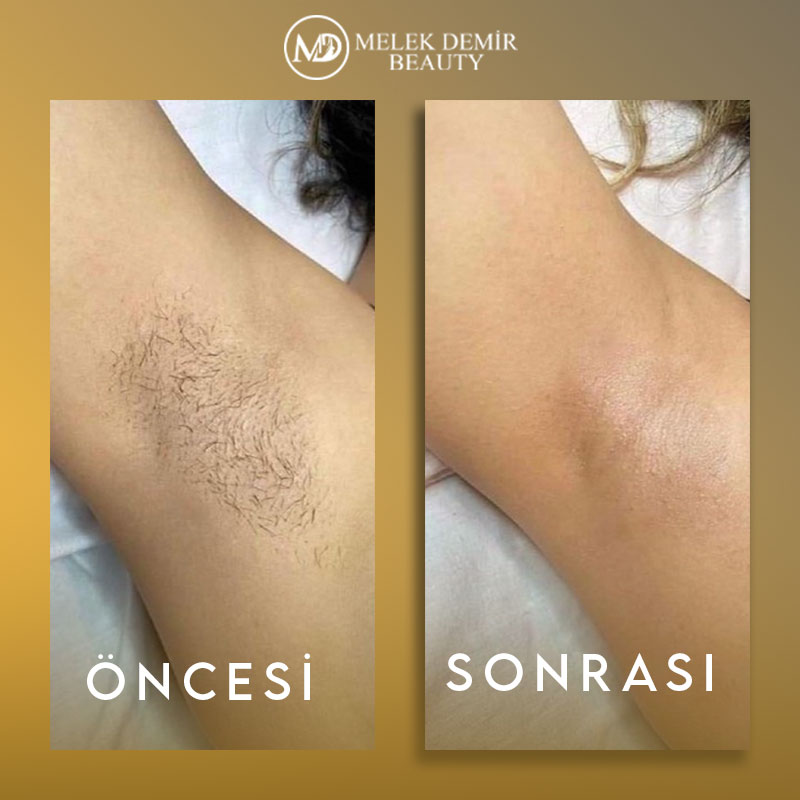 before-after